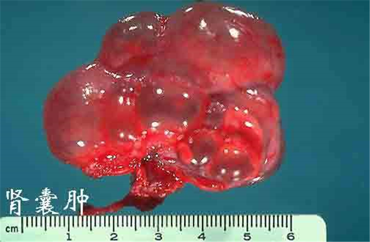 腎囊腫