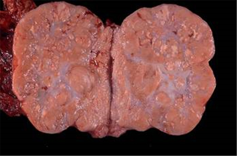 卵巢癌無性細胞瘤剖面