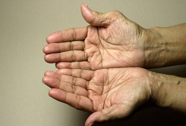 靜止性震顫 (54) 