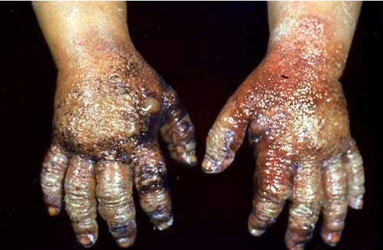 植物日光性皮炎 