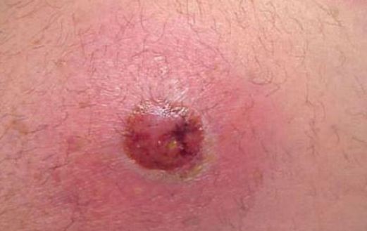 臀部癤子的症狀