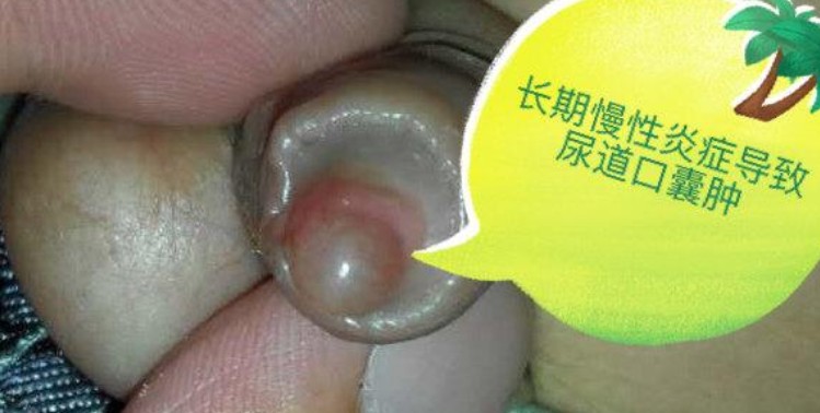 尿道口紅腫 (38) 