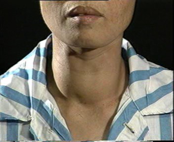 橋本甲狀腺炎中期症狀