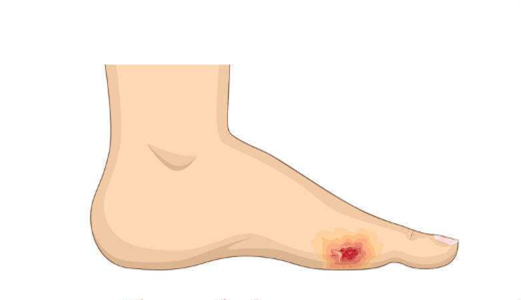 脈管炎早期症狀