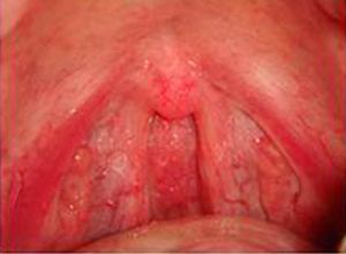 小孩急性咽炎的症狀的