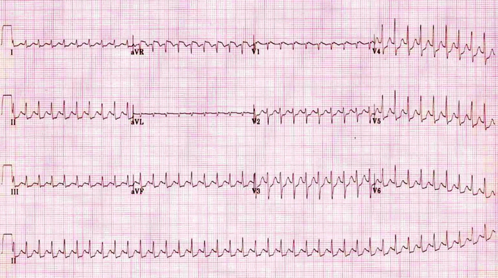 房顫心電圖特點 (63) 