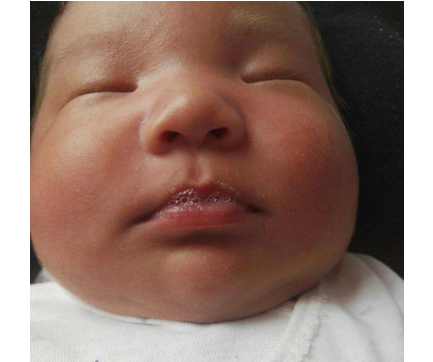 新生兒肺炎吐泡泡 (48) 