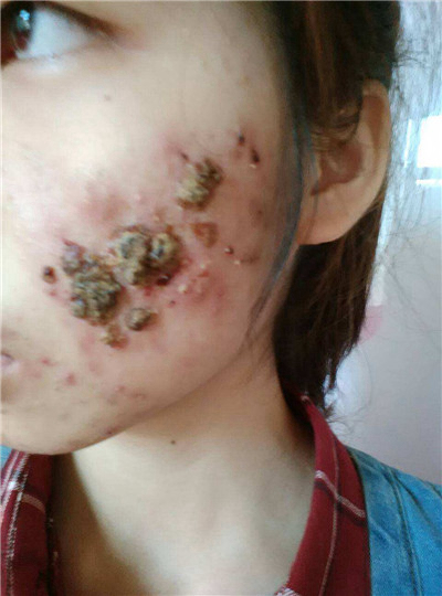 血熱的症狀痘痘