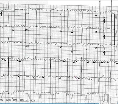 高鉀血癥心電圖 (48) 