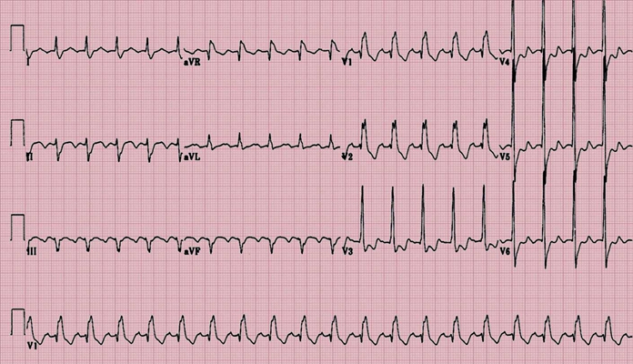 頻發房性早搏 (6) 