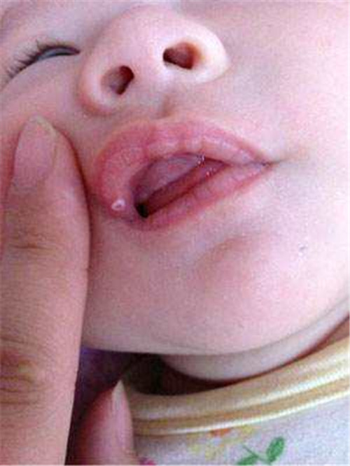 嬰兒白色念珠菌感染 