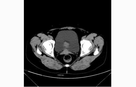 肋間神經炎疼痛部位
