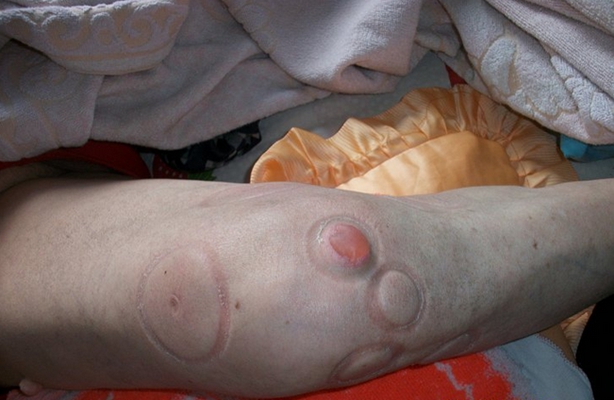 膝蓋骨質增生 (41) 