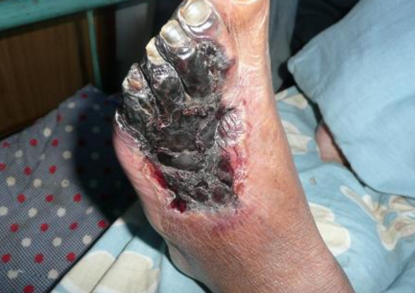 脈管炎早期症狀