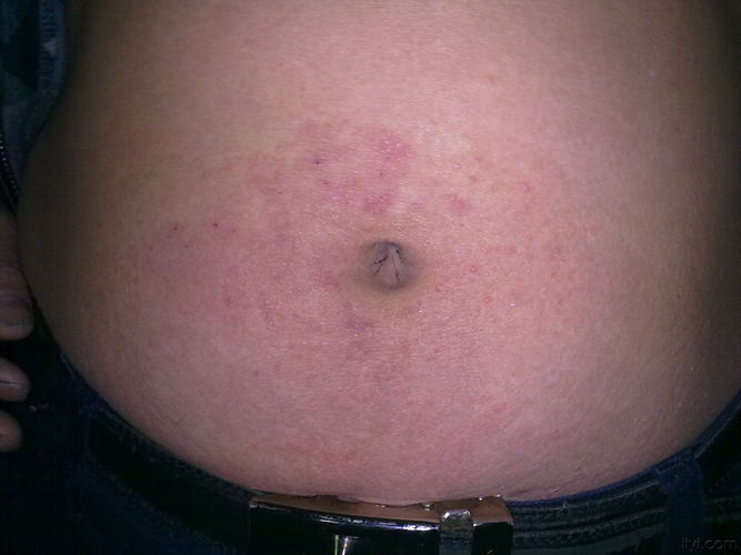 腹部接觸性皮炎