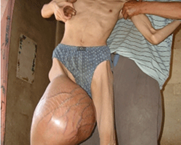 右腿部巨大骨肉瘤