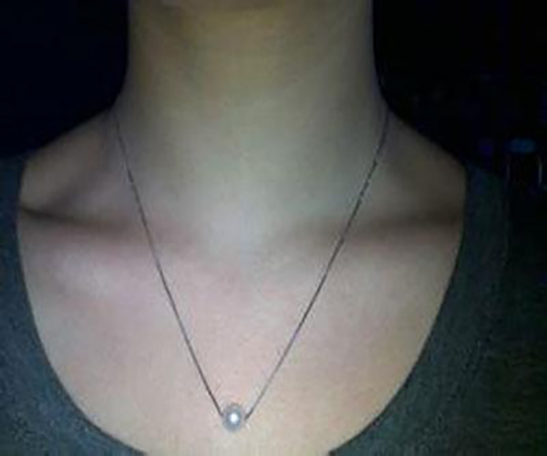 慢性淋巴甲狀腺炎