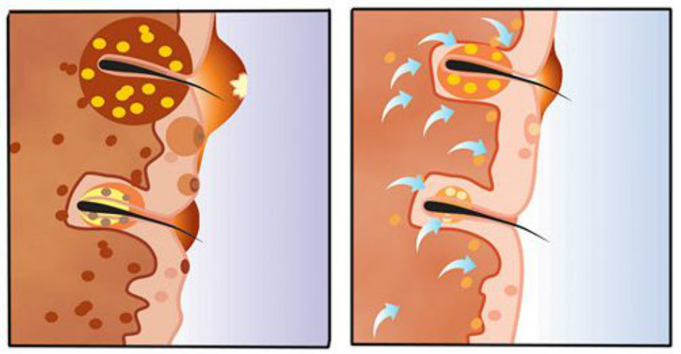 皮囊炎的漫畫圖 