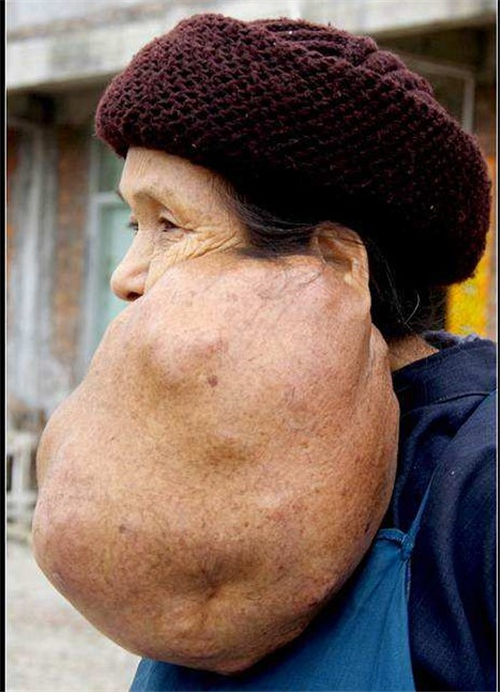 十分巨大的甲狀腺結節