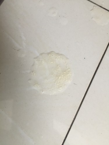 不正常精液液化