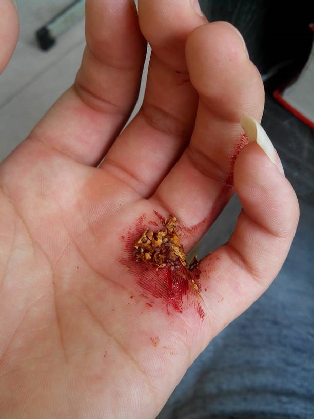 汙染的破傷風傷口