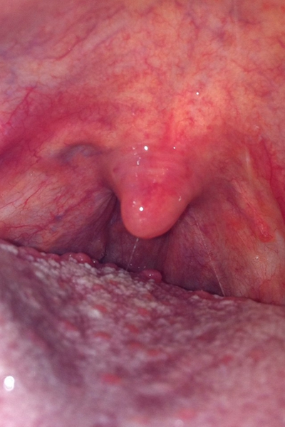 喉部淋巴濾泡增生 (4) 