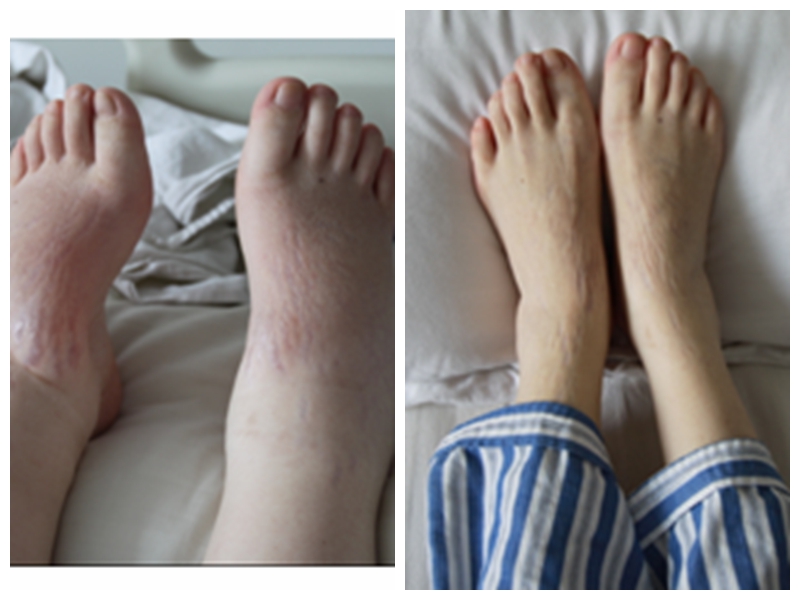 糖尿病腎病腿部腫起對比