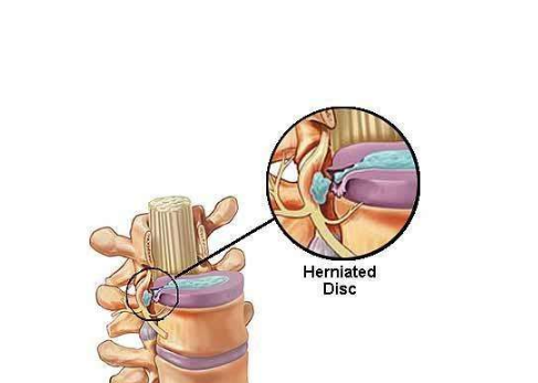 坐骨神經痛的症狀圖 (9) 
