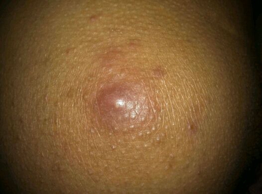 臀部癤子的症狀