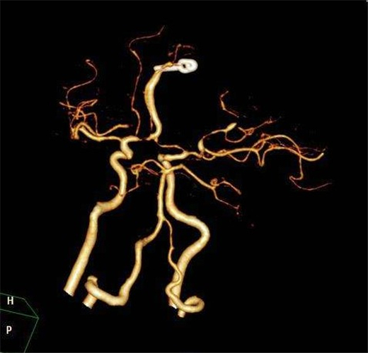 腦血管痙攣造影