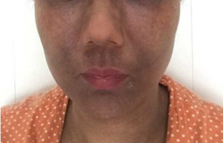 職業性皮膚黑變病表現