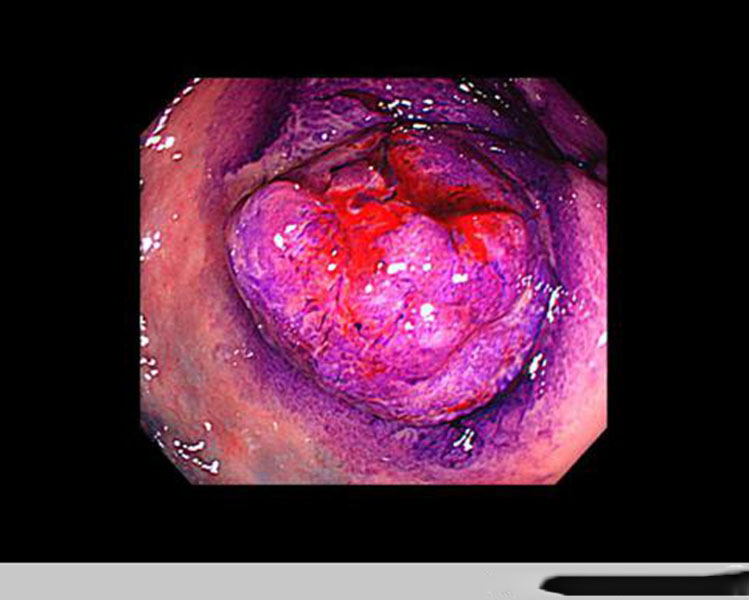 腫瘤病變腸腫瘤