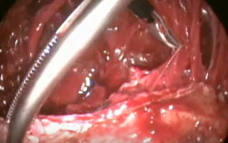 結核性胸膜炎胸腔的積液