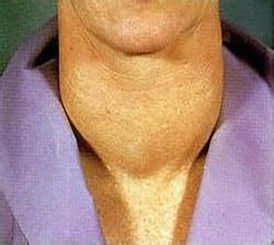 橋本氏甲狀腺炎症狀表現的