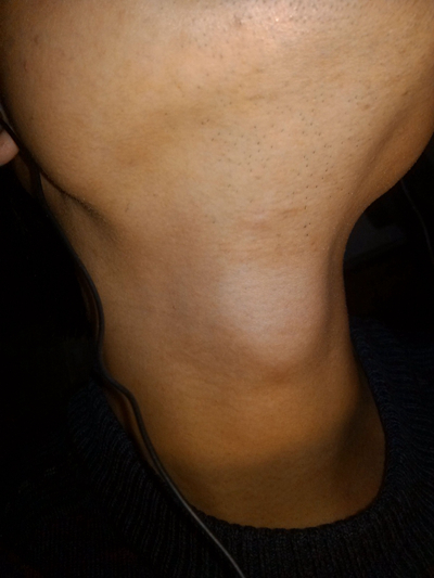 頜下淋巴結腫大