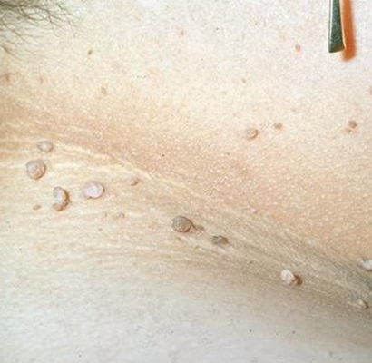 皮膚纖維瘤 (49) 