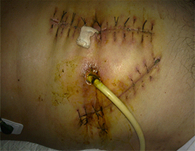 手術引發腸粘連