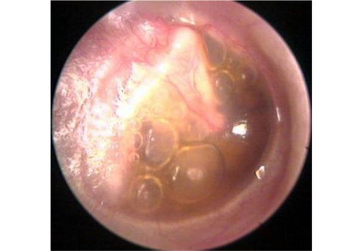 小孩急性中耳炎