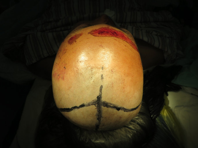 雙側額葉進展性出血腦疝手術