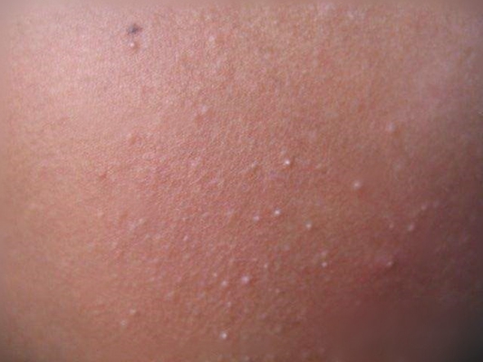 粟丘疹 (9) 