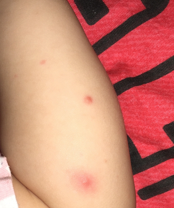 症狀流感腿部真實