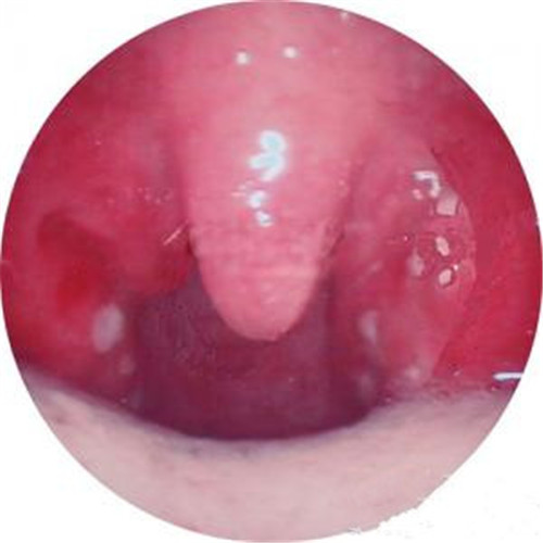 口腔內呼吸道感染