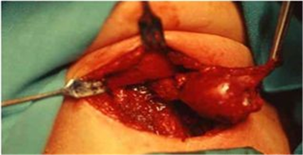 手術治療甲狀腺癌