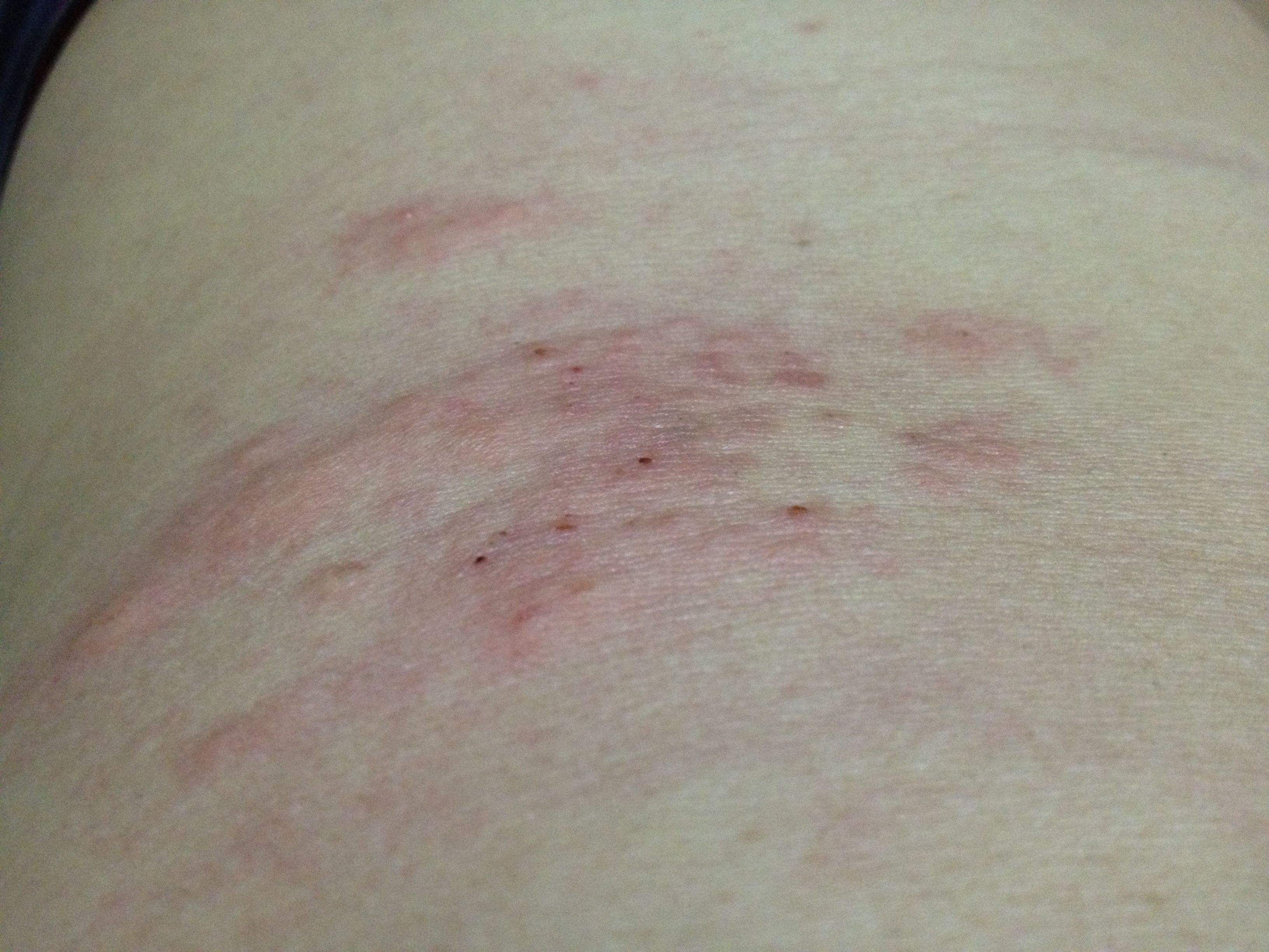 被跳蚤咬的症狀