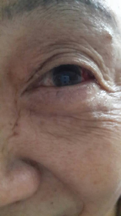 眼睛裡有血塊