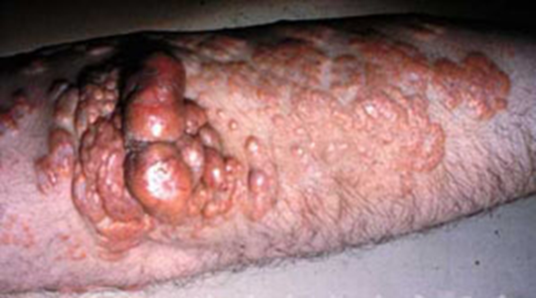 嚴重皮膚黃色瘤病