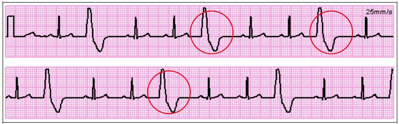頻發房性早搏 (47) 