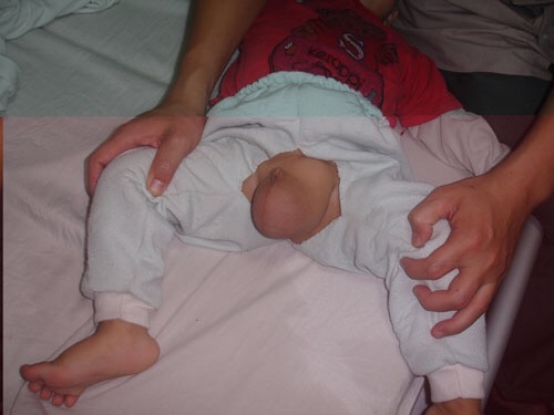 小兒鞘膜積液 (41) 