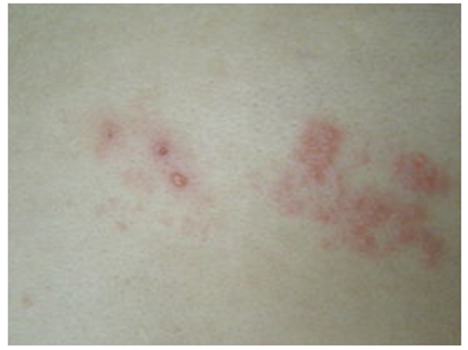 玫瑰疹病毒會造成小兒急疹 