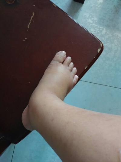 肢端肥大症  (6) 